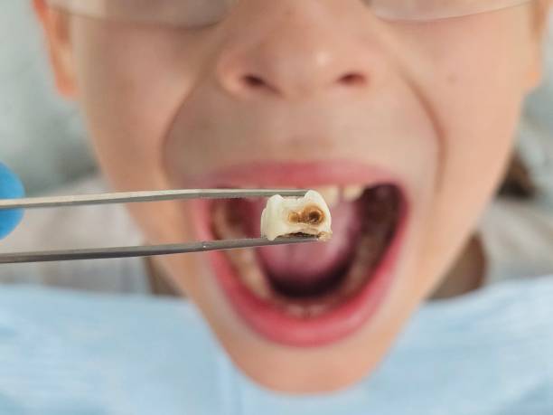 Best Emergency Dental Care for Broken or Chipped Teeth in East Patchogue, NY